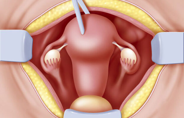 استئصال الرحم بطريق البطن: أسبابه وطريقة إجرائه والتعافي بعده