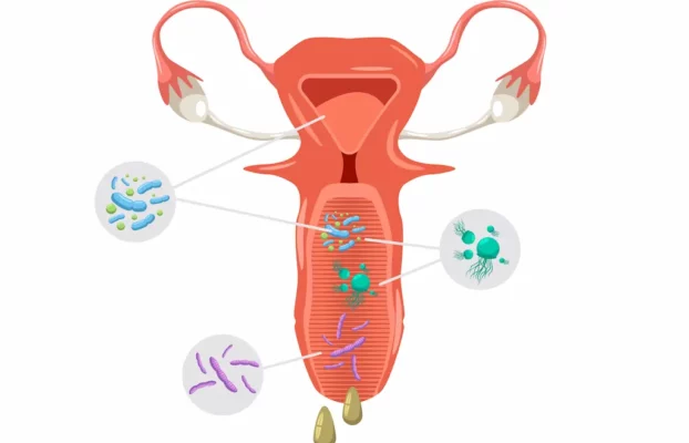 كيف يتم تشخيص وعلاج التهاب المهبل والحكة في البيت و من قبل الأطباء؟