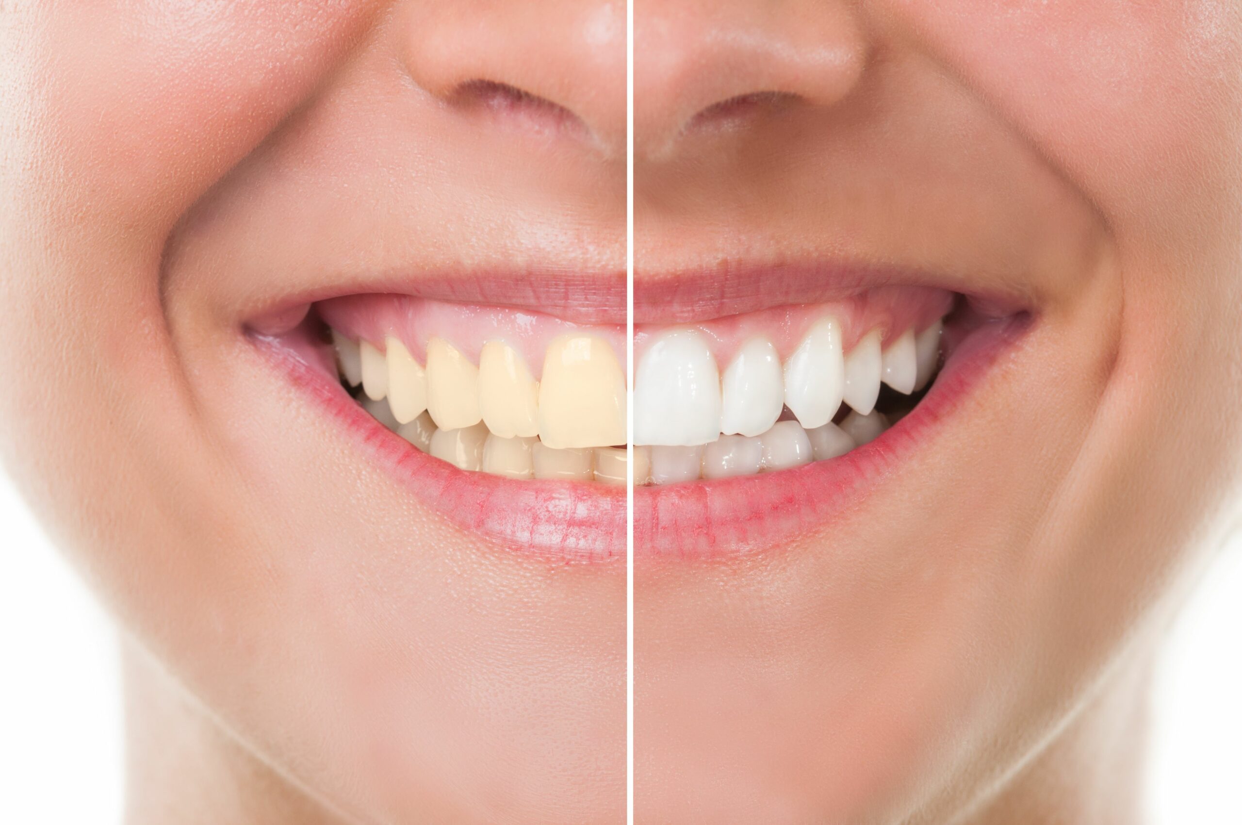 Teeth Whitening and Cleaning