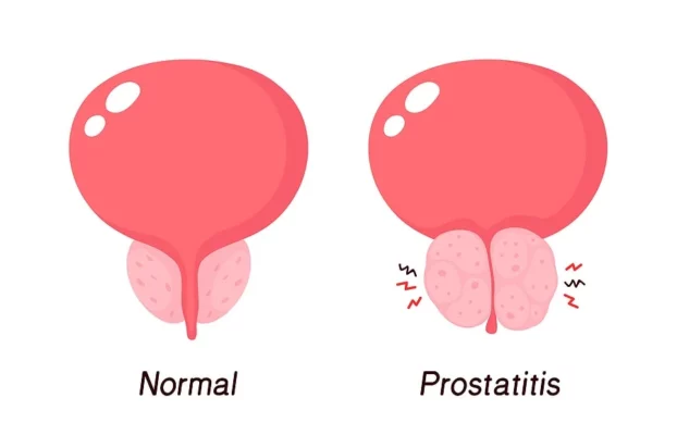 التهاب البروستاتا المزمن: أسبابه ال10 وأعراضه وعلاجه