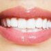 Teeth Whitening and Cleaning
