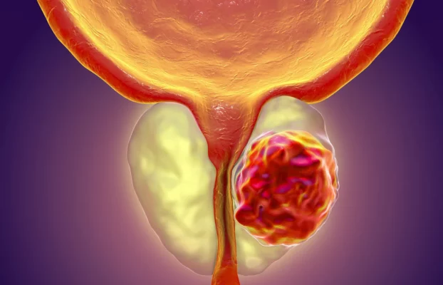 حصوات البروستاتا: أسبابها وتشخيصها وعلاجها