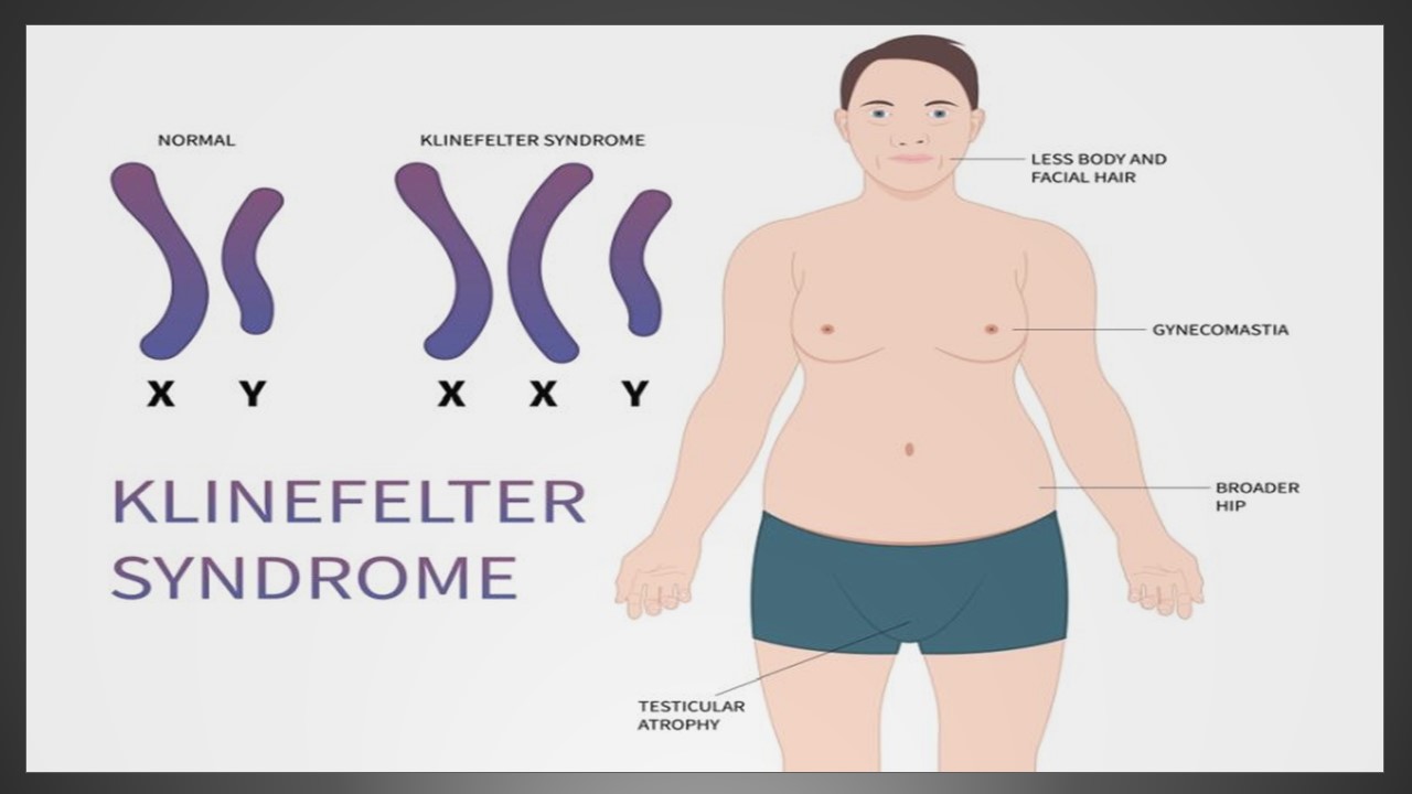 أهم 5 أسباب متلازمة كلينفلتر عند الرجال وتأثيرها على الصحة