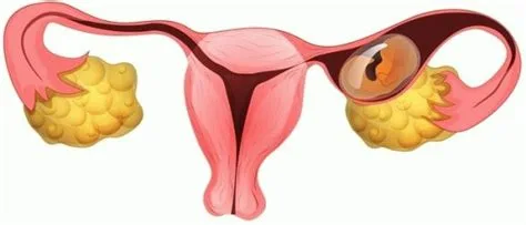 الحمل خارج الرحم: أسبابه، أعراضه، وطرق العلاج