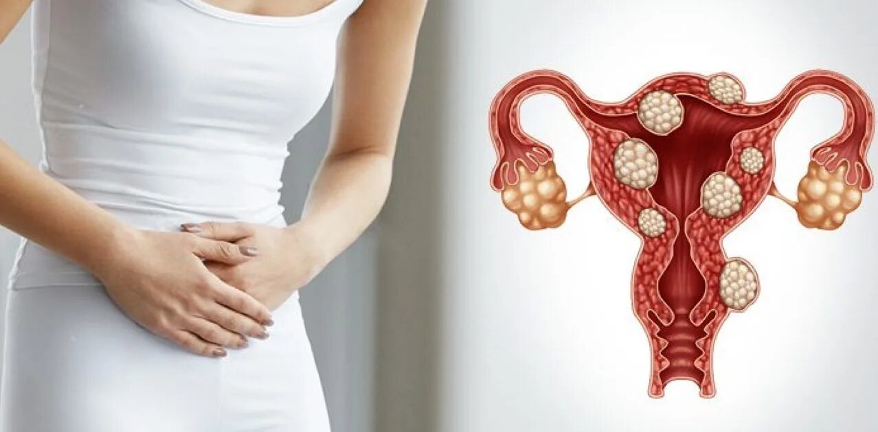 مشاكل العقم عند النساء: الأسباب، الأعراض، وسبل العلاج