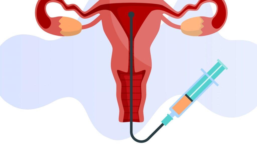 عملية الحقن داخل الرحم