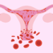 اضطرابات الدورة الشهرية