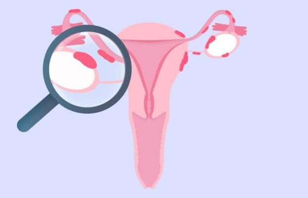 5 من أسباب الانتباذ البطاني الرحمي لم تكن تعرفها