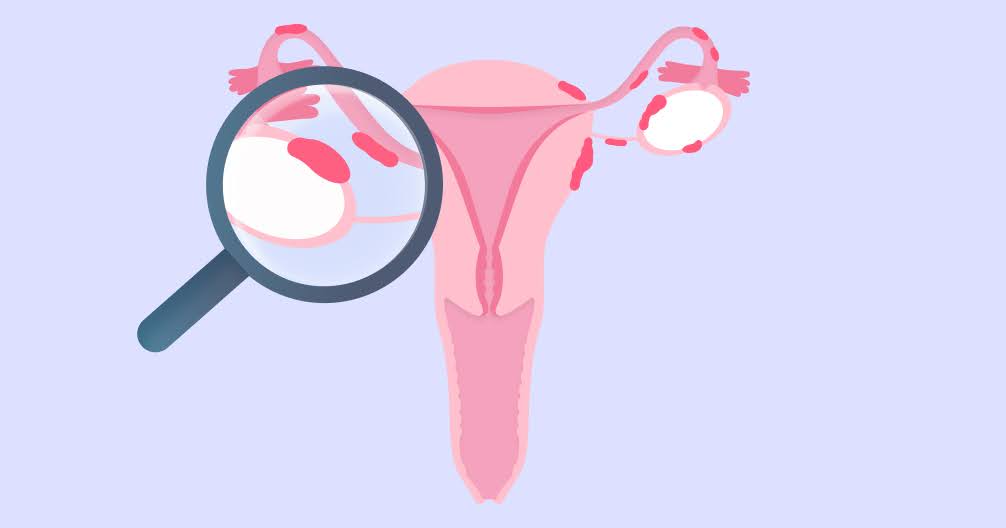 5 من أسباب الانتباذ البطاني الرحمي لم تكن تعرفها