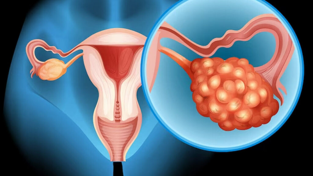 علامات تكيس المبايض
