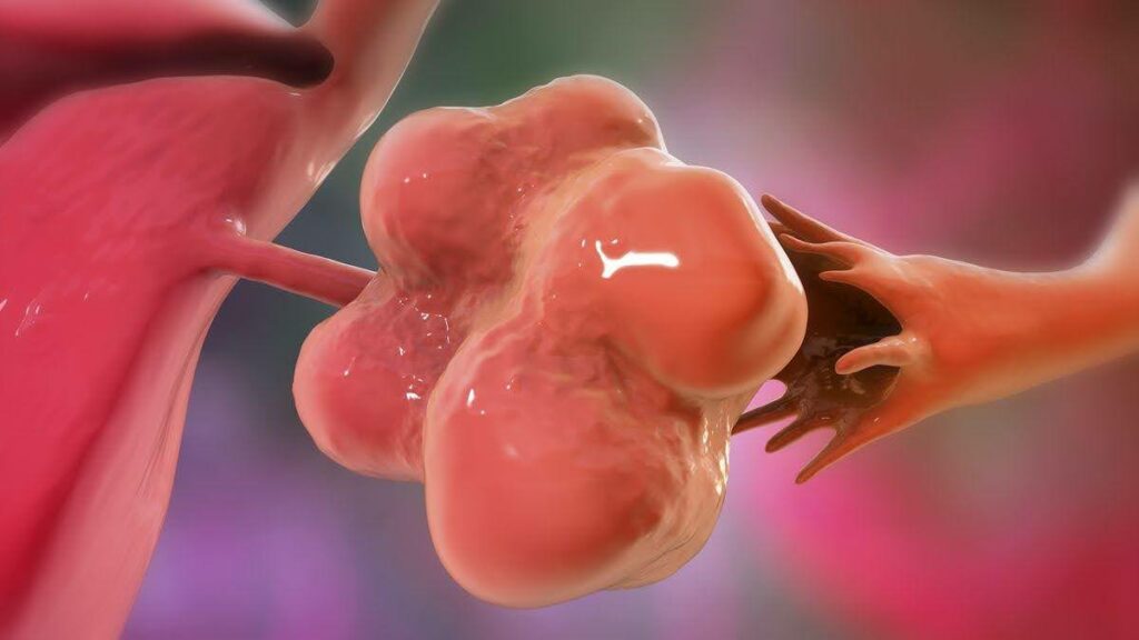 تحاليل للكشف عن تكيس المبايض