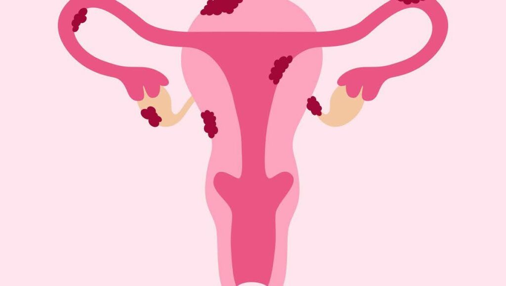 الانتباذ البطاني الرحمي والحمل