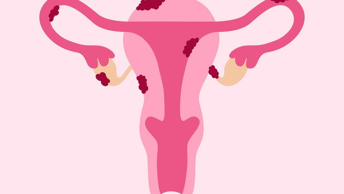 الانتباذ البطاني الرحمي والحمل: هل يحصل حمل رغم وجود بطانة الرحم المهاجرة؟