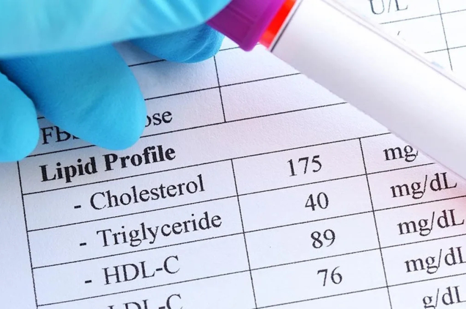 تحليل الكولسترول والدهون الثلاثية