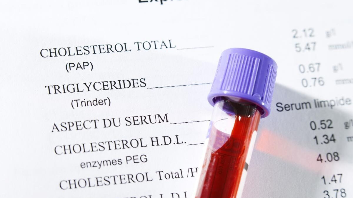 تحليل الكولسترول والدهون الثلاثية